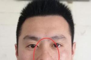 鼻翼有疤痕面相 鼻子有疤痕对面相有什么影响