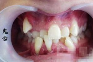 门牙缺损面相 门牙缺损的修复方法